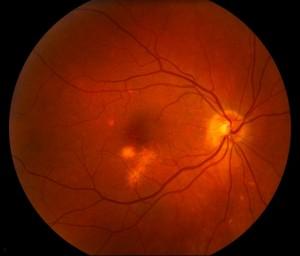 Close up of eye disorder | Gold Coast Optometrist
